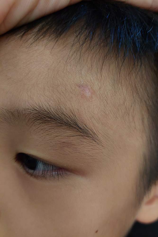 小孩縫針後,剛拆線完