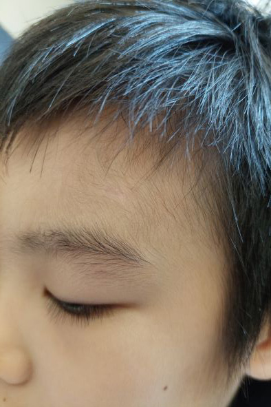 小孩縫針拆線二個月後的疤痕