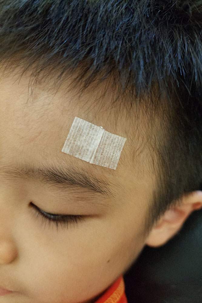 小孩受傷縫針後,剛拆線完,繼續使用美容膠帶